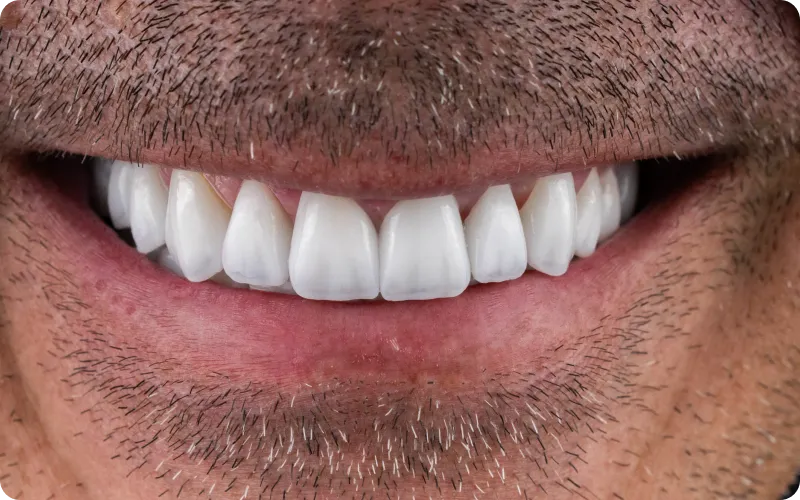 Sorriso com facetas de porcelana no Instituto Ávita