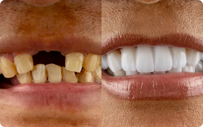 Antes e depois de reabilitação com implante dentário no Instituto Ávita