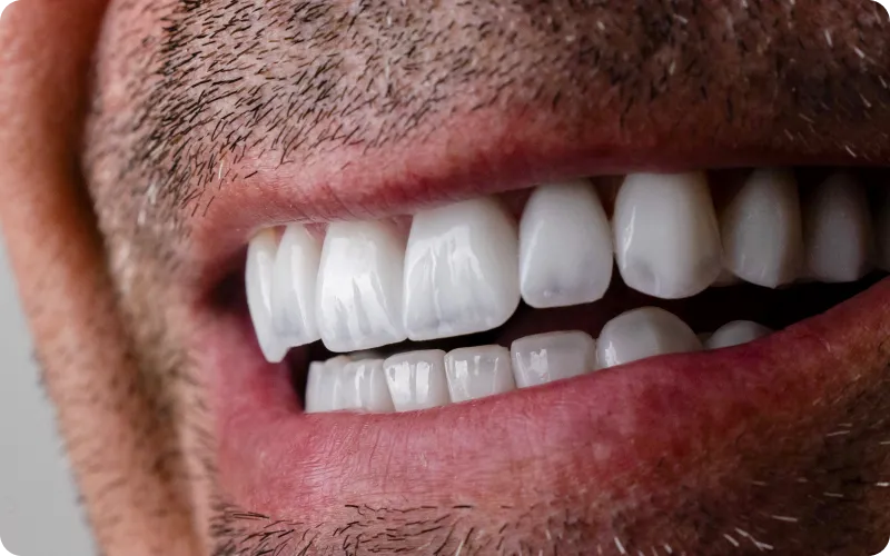 Detalhe de sorriso transformado no Instituto Ávita